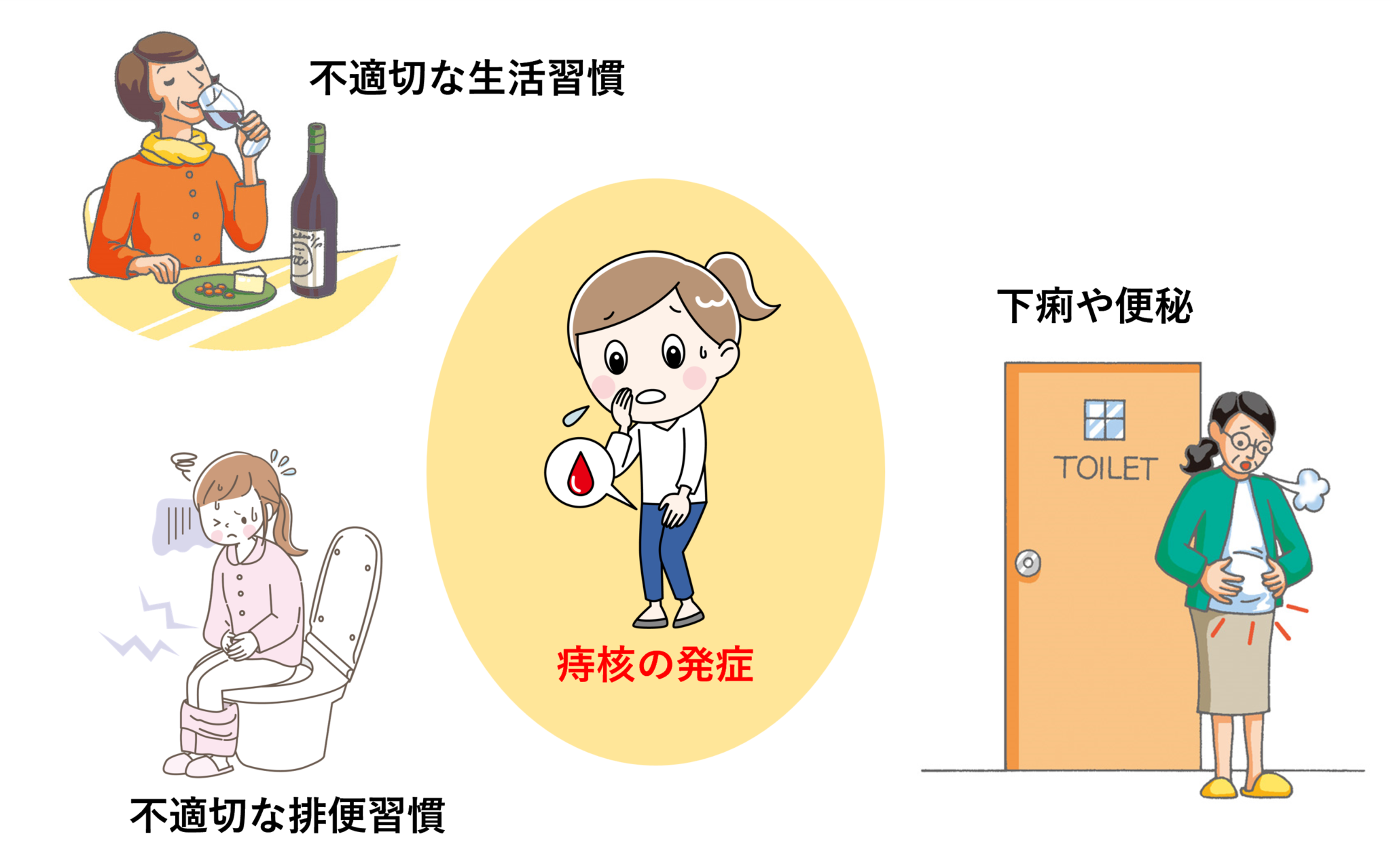 いぼ痔 痔核|いまがわ外科クリニック|大阪市都島区の内科・外科・整形外科・肛門科・形成外科・美容診療・消化器内科