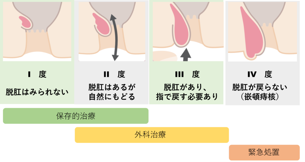 内痔核の重症度分類　goligher分類　いまがわ外科クリニック