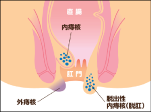 内痔核　外痔核　脱肛