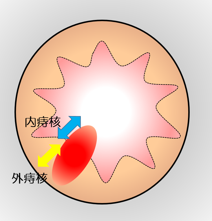 内痔核と外痔核はどちらがひどいのでしょうか？