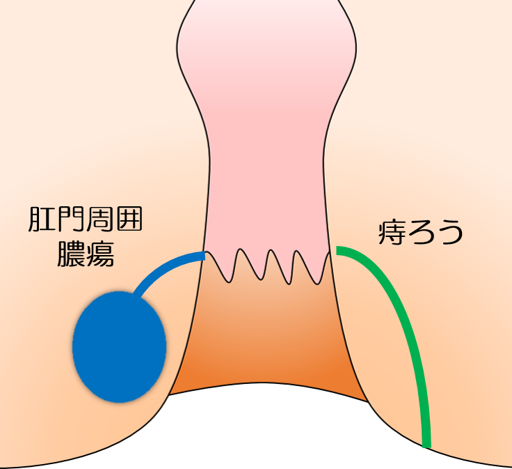 痔瘻・肛門周囲膿瘍の説明図