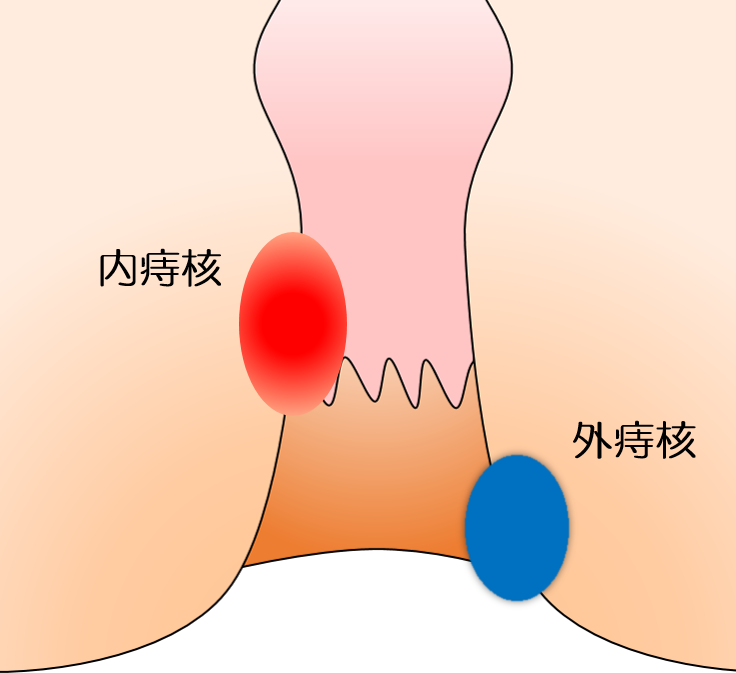 いぼ痔(痔核)の説明図