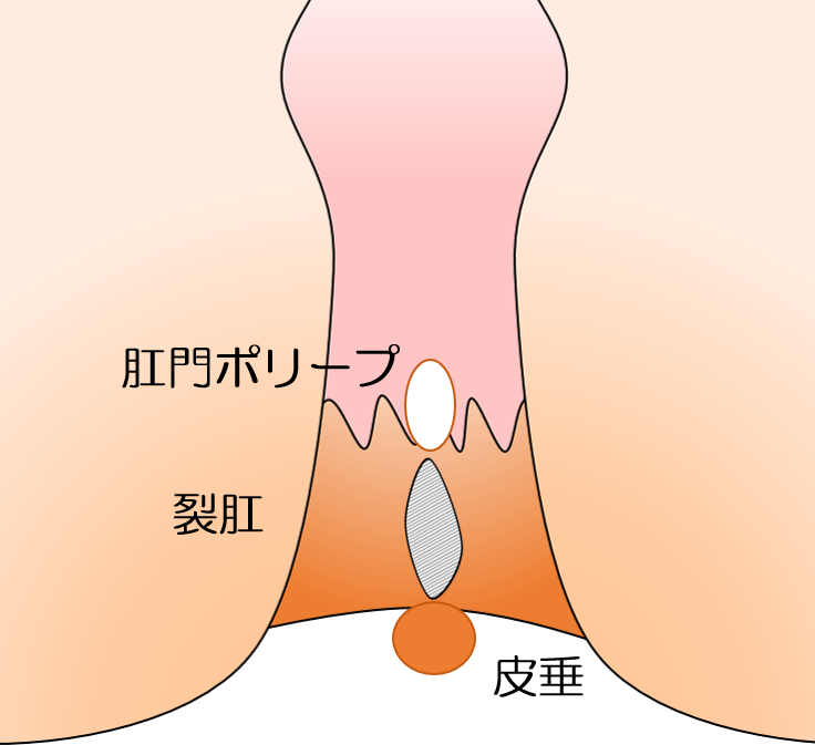 きれ痔(裂肛)の説明図